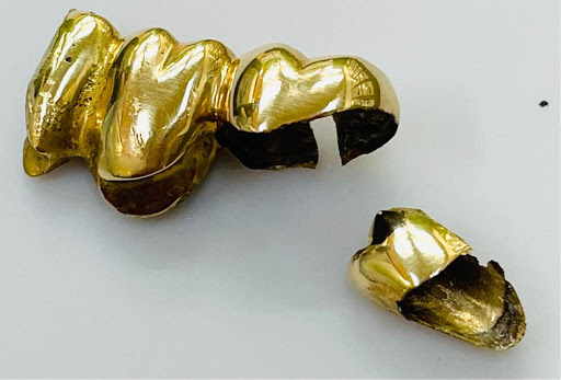 金歯